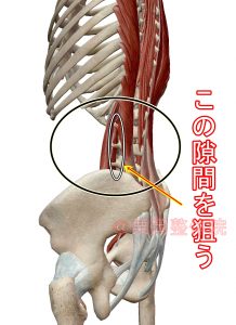 大腰筋と脊柱起立筋の隙間の狙う位置