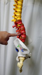 椎間板ヘルニア背骨模型